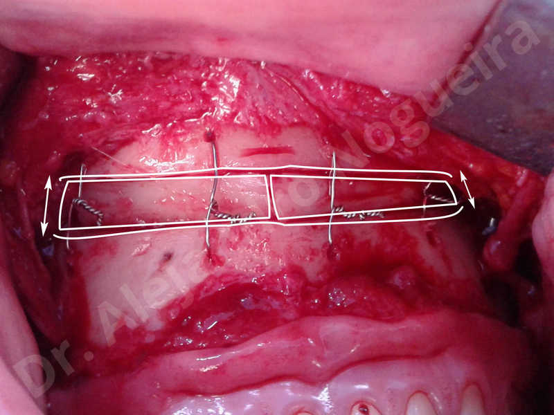Small chin,Weak chin,Elbow bone graft harvesting,Oblique chin osteotomy,Osseous chin advancement,Two dimensional genioplasty,Vertical osseous chin grafting - photo 27