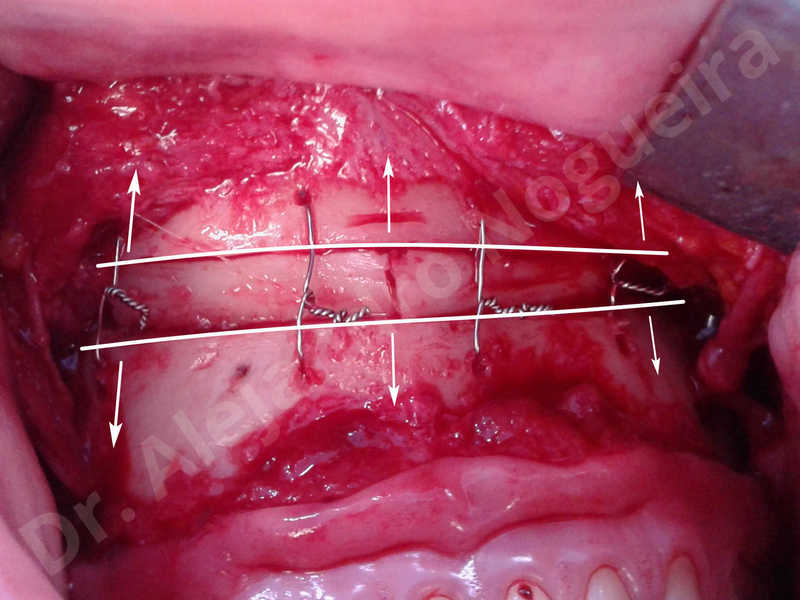 Small chin,Weak chin,Elbow bone graft harvesting,Oblique chin osteotomy,Osseous chin advancement,Two dimensional genioplasty,Vertical osseous chin grafting - photo 28