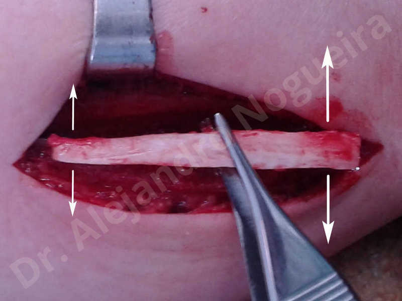 Small chin,Weak chin,Elbow bone graft harvesting,Oblique chin osteotomy,Osseous chin advancement,Two dimensional genioplasty,Vertical osseous chin grafting - photo 9