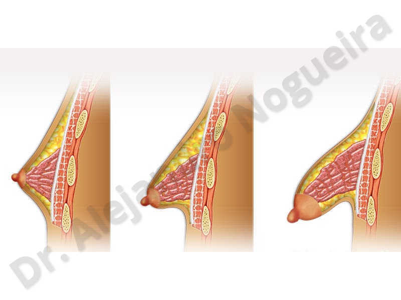 Large areolas,Tuberous breasts,Areola reduction,Tuberous mammoplasty - photo 2