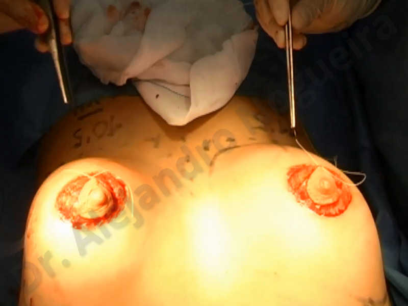 Asymmetric breasts,Empty breasts,Large areolas,Small breasts,Too far apart wide cleavage breasts,Tuberous breasts,Anatomical shape,Areola reduction,Subfascial pocket plane,Tuberous mammoplasty,Circumareolar incision,Lower hemi periareolar incision - photo 162
