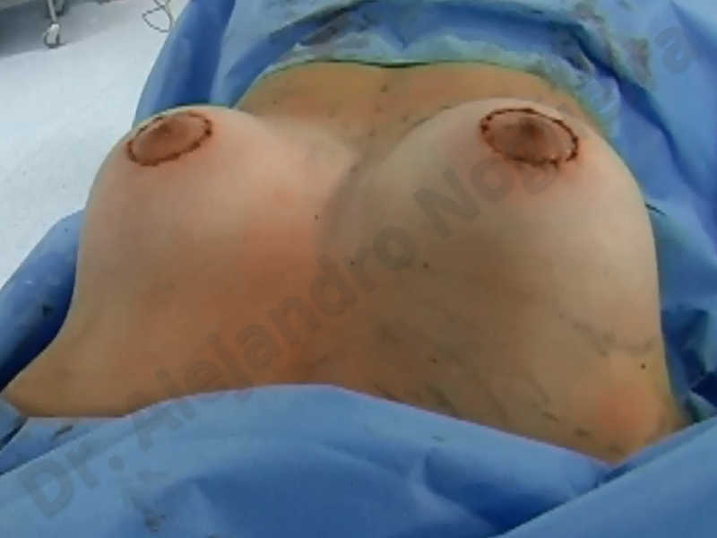 Asymmetric breasts,Empty breasts,Large areolas,Small breasts,Too far apart wide cleavage breasts,Tuberous breasts,Anatomical shape,Areola reduction,Subfascial pocket plane,Tuberous mammoplasty,Circumareolar incision,Lower hemi periareolar incision - photo 167