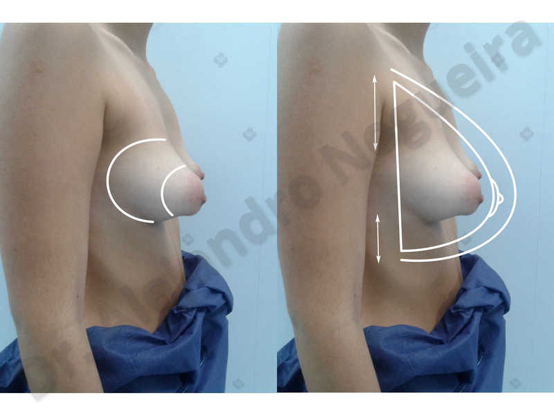 Asymmetric breasts,Empty breasts,Large areolas,Small breasts,Too far apart wide cleavage breasts,Tuberous breasts,Anatomical shape,Areola reduction,Subfascial pocket plane,Tuberous mammoplasty,Circumareolar incision,Lower hemi periareolar incision - photo 3