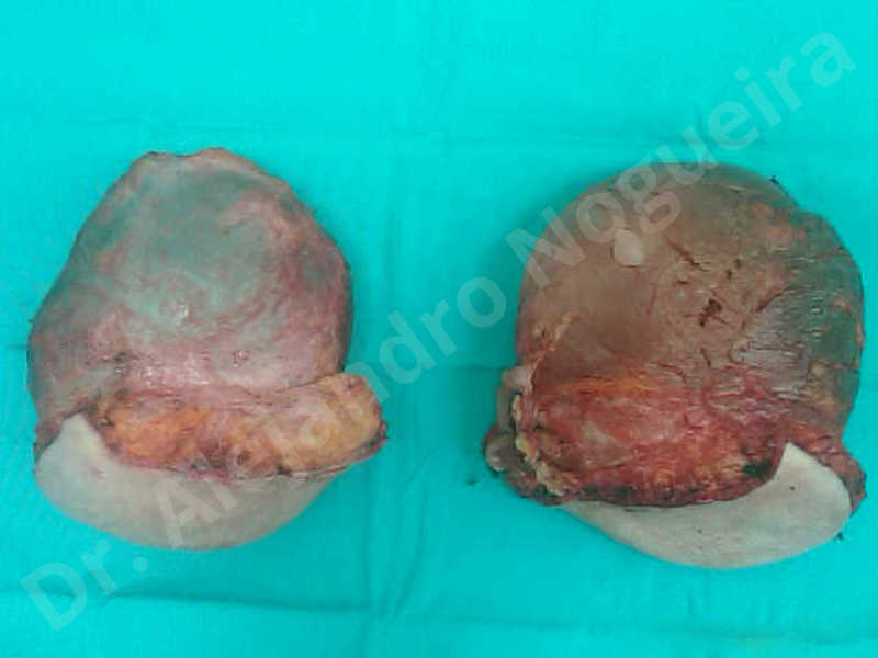 Breast implants bottoming out,Breast implants capsular contracture,Breast implants displacement malposition,Breast implants riding too high,Cross eyed breasts implants,Lateral breasts,Moderately large breasts,Pendulous breasts,Severely saggy droopy breasts,Too far apart wide cleavage breasts,Wide breasts,Capsulectomy - photo 4