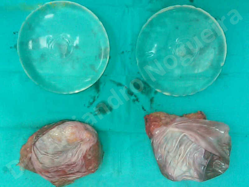 Breast implants bottoming out,Breast implants capsular contracture,Breast implants displacement malposition,Breast implants riding too high,Cross eyed breasts implants,Lateral breasts,Moderately large breasts,Pendulous breasts,Severely saggy droopy breasts,Too far apart wide cleavage breasts,Wide breasts,Capsulectomy - photo 5
