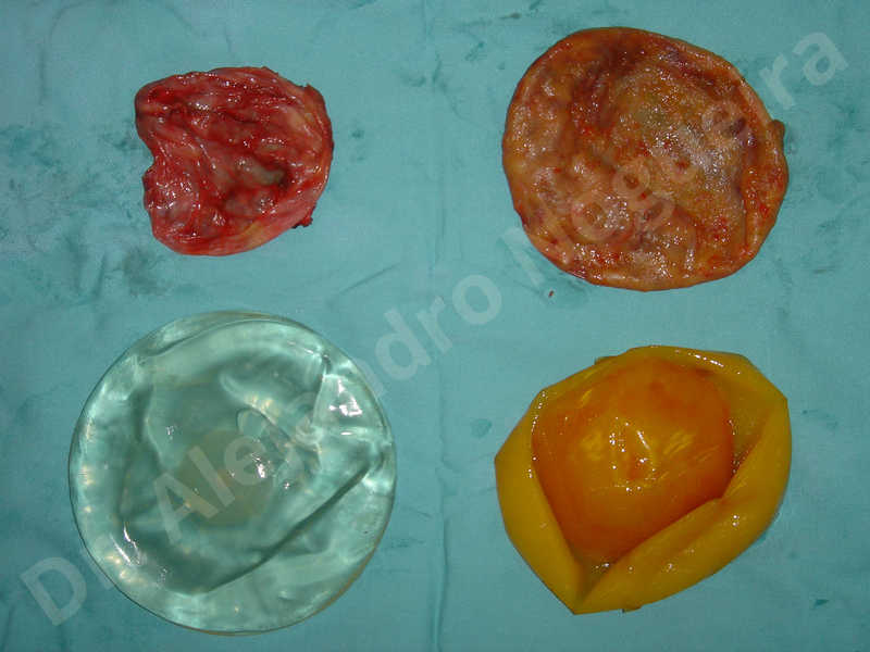 Asymmetric breasts,Breast implants capsular contracture,Breast implants capsule calcification,Breast implants displacement malposition,Breast implants riding too high,Broken breast implants,Slightly saggy droopy breasts,Too far apart wide cleavage breast implants,Too narrow breast implants,Waterfall effect breast implants,Capsulectomy - photo 13
