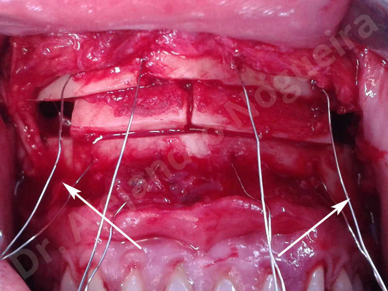 Small chin,Weak chin,Elbow bone graft harvesting,Oblique chin osteotomy,Osseous chin advancement,Two dimensional genioplasty,Vertical osseous chin grafting - photo 19
