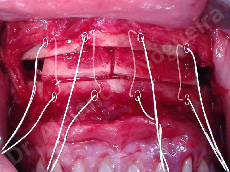 Small chin,Weak chin,Elbow bone graft harvesting,Oblique chin osteotomy,Osseous chin advancement,Two dimensional genioplasty,Vertical osseous chin grafting - photo 21
