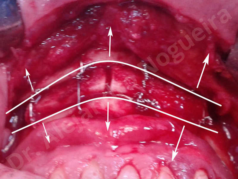 Small chin,Weak chin,Elbow bone graft harvesting,Oblique chin osteotomy,Osseous chin advancement,Two dimensional genioplasty,Vertical osseous chin grafting - photo 26
