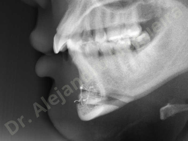 Small chin,Weak chin,Elbow bone graft harvesting,Oblique chin osteotomy,Osseous chin advancement,Two dimensional genioplasty,Vertical osseous chin grafting - photo 32