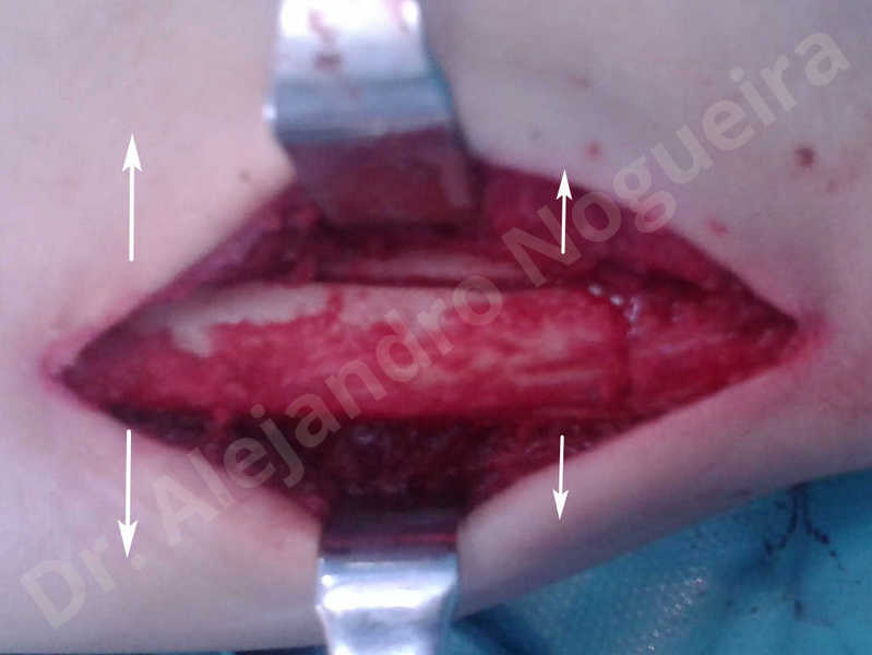 Small chin,Weak chin,Elbow bone graft harvesting,Oblique chin osteotomy,Osseous chin advancement,Two dimensional genioplasty,Vertical osseous chin grafting - photo 4