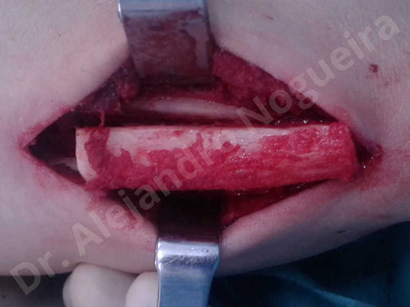 Small chin,Weak chin,Elbow bone graft harvesting,Oblique chin osteotomy,Osseous chin advancement,Two dimensional genioplasty,Vertical osseous chin grafting - photo 7