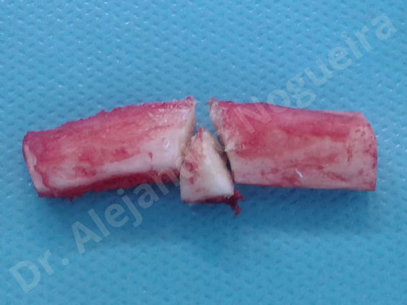 Small chin,Weak chin,Elbow bone graft harvesting,Oblique chin osteotomy,Osseous chin advancement,Two dimensional genioplasty,Vertical osseous chin grafting - photo 9