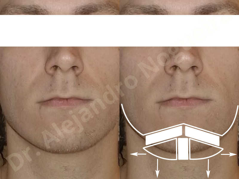 Small chin,Weak chin,Hip bone graft harvesting,Horizontal osseous chin grafting,Oblique chin osteotomy,Three dimensional genioplasty,Vertical osseous chin grafting - photo 1