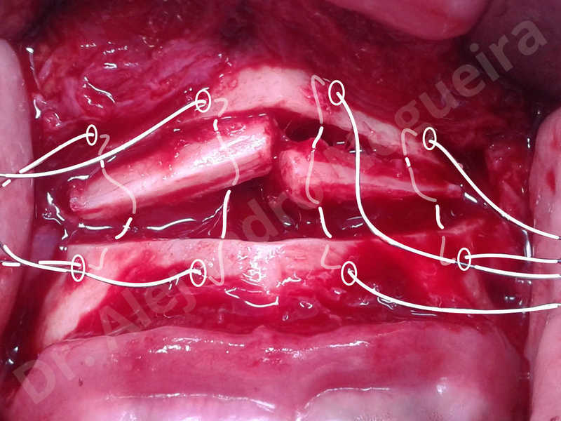 Small chin,Weak chin,Elbow bone graft harvesting,Oblique chin osteotomy,Osseous chin advancement,Two dimensional genioplasty,Vertical osseous chin grafting - photo 10