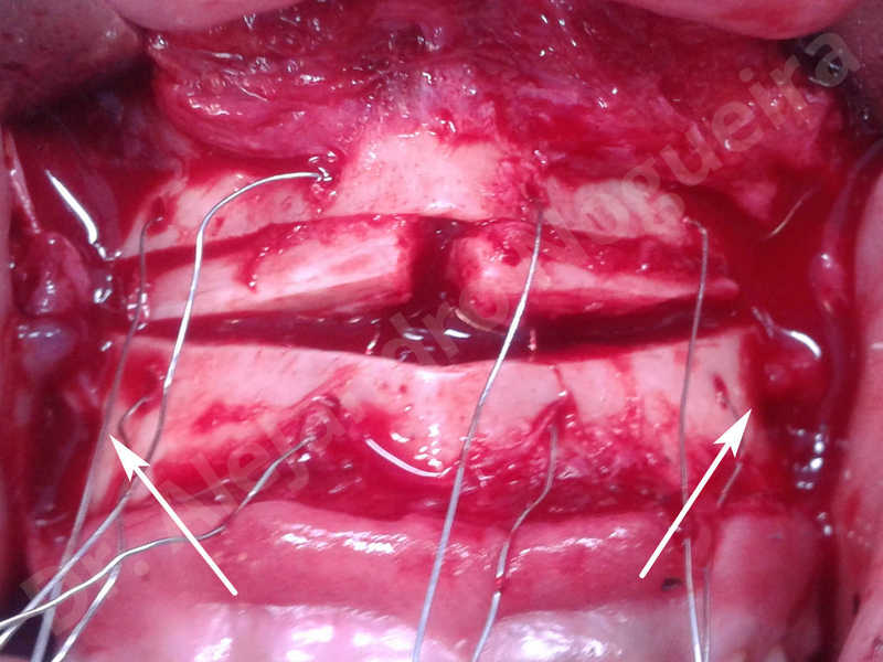 Small chin,Weak chin,Elbow bone graft harvesting,Oblique chin osteotomy,Osseous chin advancement,Two dimensional genioplasty,Vertical osseous chin grafting - photo 11