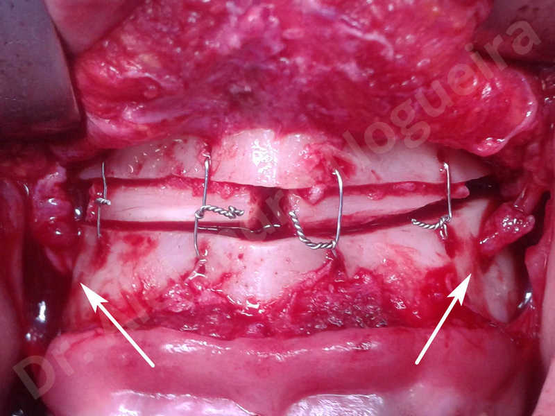 Small chin,Weak chin,Elbow bone graft harvesting,Oblique chin osteotomy,Osseous chin advancement,Two dimensional genioplasty,Vertical osseous chin grafting - photo 13