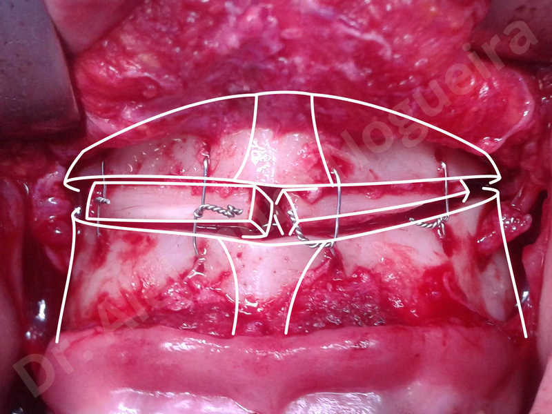 Small chin,Weak chin,Elbow bone graft harvesting,Oblique chin osteotomy,Osseous chin advancement,Two dimensional genioplasty,Vertical osseous chin grafting - photo 14