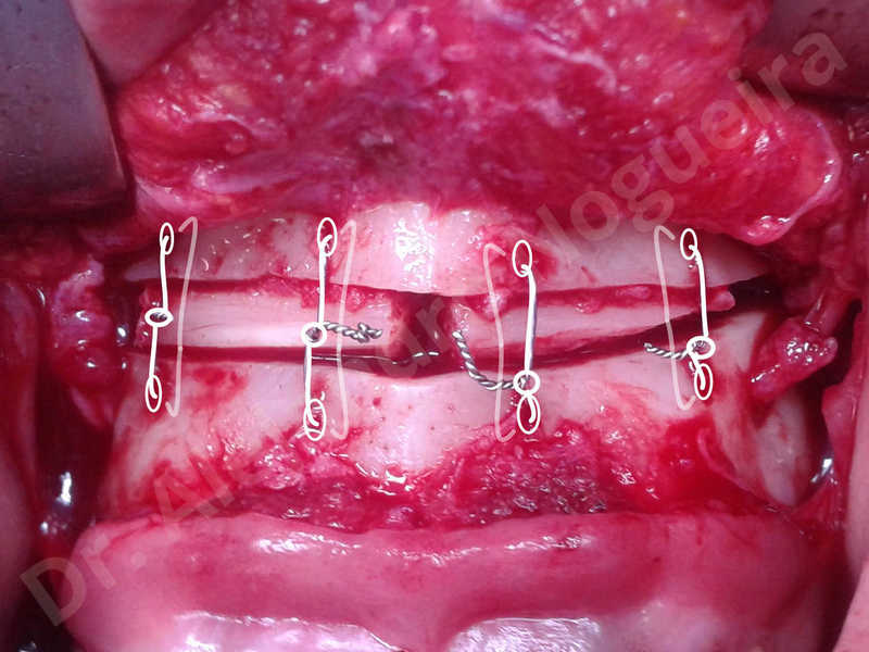 Small chin,Weak chin,Elbow bone graft harvesting,Oblique chin osteotomy,Osseous chin advancement,Two dimensional genioplasty,Vertical osseous chin grafting - photo 15