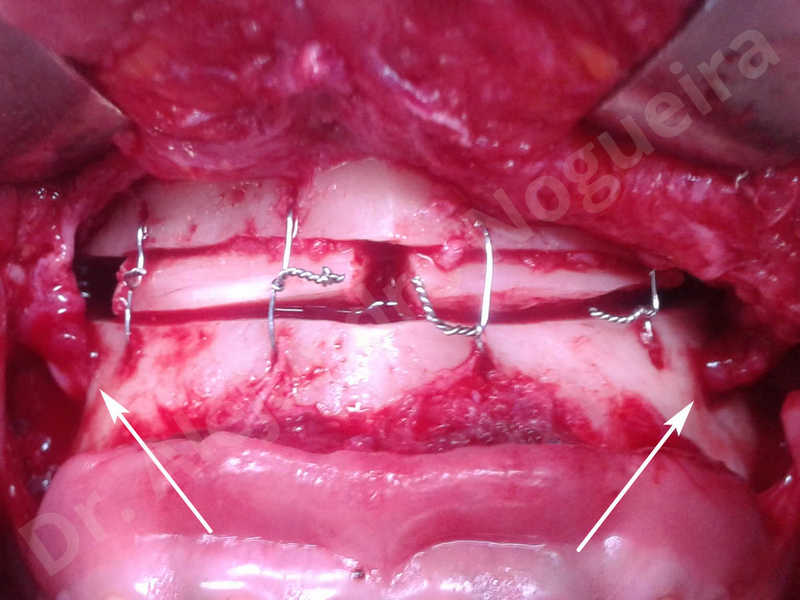 Small chin,Weak chin,Elbow bone graft harvesting,Oblique chin osteotomy,Osseous chin advancement,Two dimensional genioplasty,Vertical osseous chin grafting - photo 17