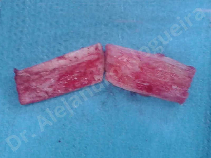 Small chin,Weak chin,Elbow bone graft harvesting,Oblique chin osteotomy,Osseous chin advancement,Two dimensional genioplasty,Vertical osseous chin grafting - photo 6
