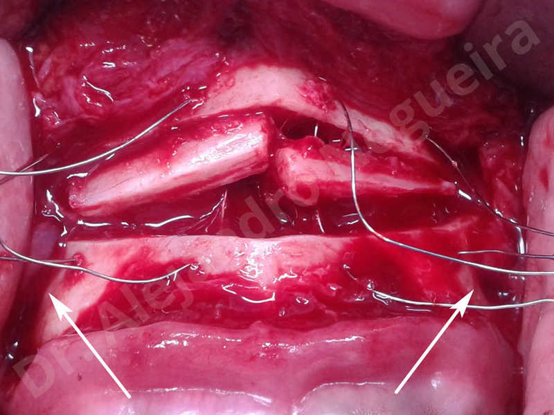 Small chin,Weak chin,Elbow bone graft harvesting,Oblique chin osteotomy,Osseous chin advancement,Two dimensional genioplasty,Vertical osseous chin grafting - photo 8