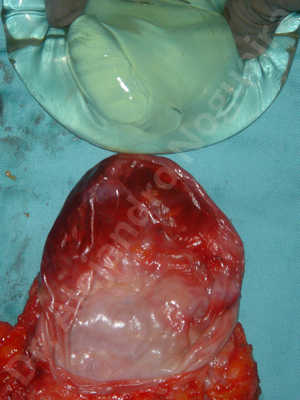 Breast implants capsular contracture,Breast implants capsule calcification,Breast implants displacement malposition,Breast implants riding too high,Breast implants visibility palpability,Broken breast implants,Cross eyed breasts implants,Moderately saggy droopy breasts,Pendulous breasts,Too far apart wide cleavage breast implants,Too far apart wide cleavage breasts,Too narrow breast implants,Waterfall effect breast implants,Capsulectomy