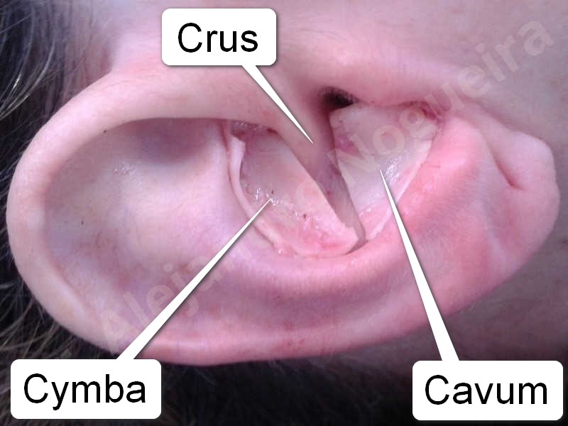 Broad nose,Bulbous tip,Crooked nose,Crooked tip,Droopy tip,Nasal fibrosis,Nasal valve collapse,Overrotated tip,Parenthesis tip deformity,Pinched middle vault,Pinched nose,Plunging tip deformity,Poorly defined tip,Poorly supported tip,Rounded tip,Short nose,Short septum,Short upper lateral cartilages,Small alar cartilages,Sunken columella,Tip bossae,Underprojected tip,Alar contour rim graft,Columella lengthening,Columella strut graft,Custom made tip graft,Ear cartilage graft harvesting,Extended columella strut graft,Intercrural columella plasty sutures,Interdomal tip plasty sutures,Lateral cruras custom made graft,Lateral cruras replacement graft,Lateral cruras repositioning,Open approach incision,Septocolumella graft,Septum caudal extension graft,Septum replacement graft,Shield tip graft,Spreader graft,Tip defatting,Tip replacement graft,Tongue in groove columella setback - photo 18