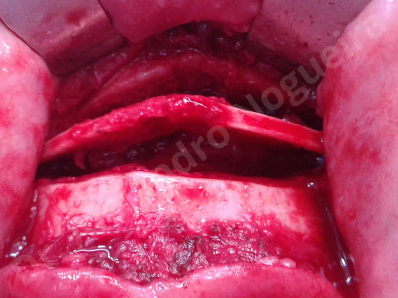 Large chin,Transgender chin,Horizontal osseous chin resection,Oblique chin osteotomy,Osseous chin setback,Three dimensional genioplasty,Vertical osseous chin resection - photo 11