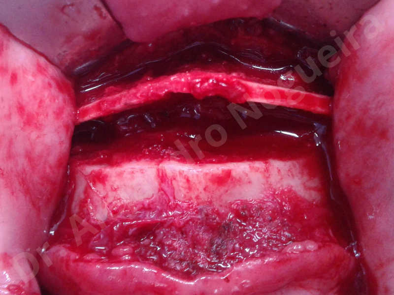 Large chin,Transgender chin,Horizontal osseous chin resection,Oblique chin osteotomy,Osseous chin setback,Three dimensional genioplasty,Vertical osseous chin resection - photo 12