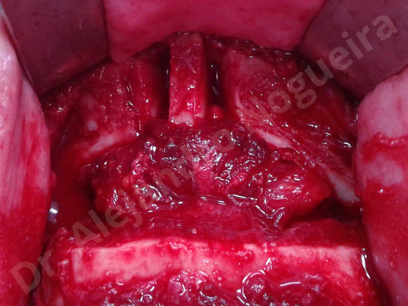 Large chin,Transgender chin,Horizontal osseous chin resection,Oblique chin osteotomy,Osseous chin setback,Three dimensional genioplasty,Vertical osseous chin resection - photo 13