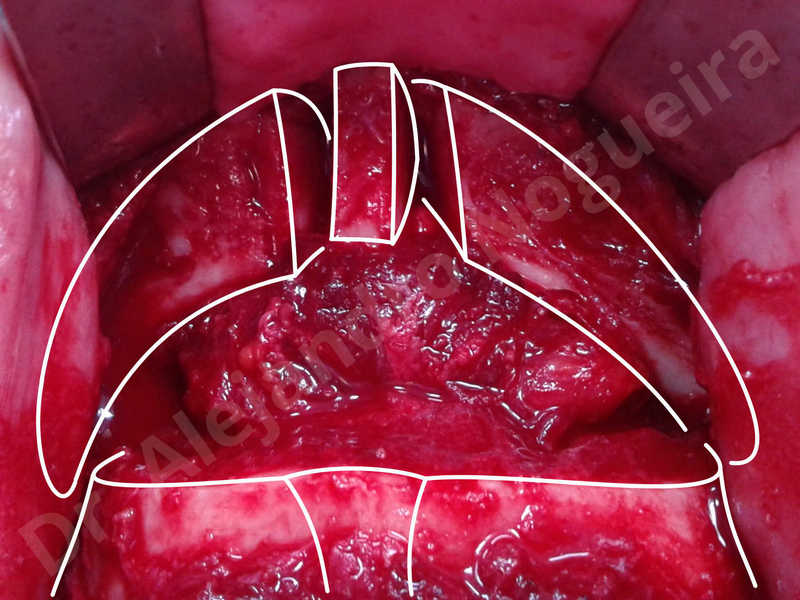 Large chin,Transgender chin,Horizontal osseous chin resection,Oblique chin osteotomy,Osseous chin setback,Three dimensional genioplasty,Vertical osseous chin resection - photo 14