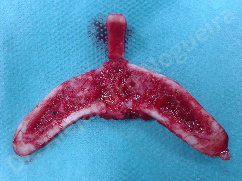 Large chin,Transgender chin,Horizontal osseous chin resection,Oblique chin osteotomy,Osseous chin setback,Three dimensional genioplasty,Vertical osseous chin resection - photo 15
