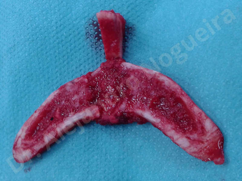 Large chin,Transgender chin,Horizontal osseous chin resection,Oblique chin osteotomy,Osseous chin setback,Three dimensional genioplasty,Vertical osseous chin resection - photo 17