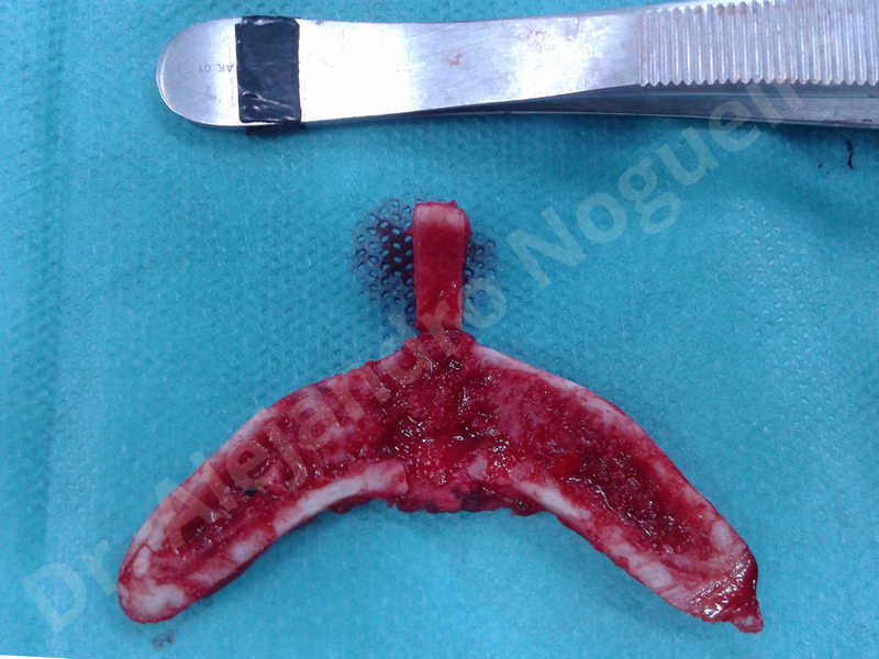 Large chin,Transgender chin,Horizontal osseous chin resection,Oblique chin osteotomy,Osseous chin setback,Three dimensional genioplasty,Vertical osseous chin resection - photo 19