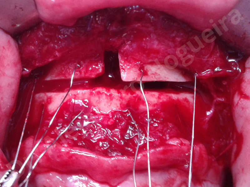 Large chin,Transgender chin,Horizontal osseous chin resection,Oblique chin osteotomy,Osseous chin setback,Three dimensional genioplasty,Vertical osseous chin resection - photo 20