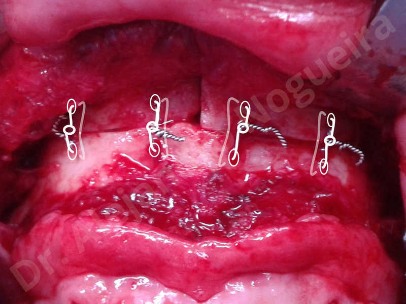 Large chin,Transgender chin,Horizontal osseous chin resection,Oblique chin osteotomy,Osseous chin setback,Three dimensional genioplasty,Vertical osseous chin resection - photo 23