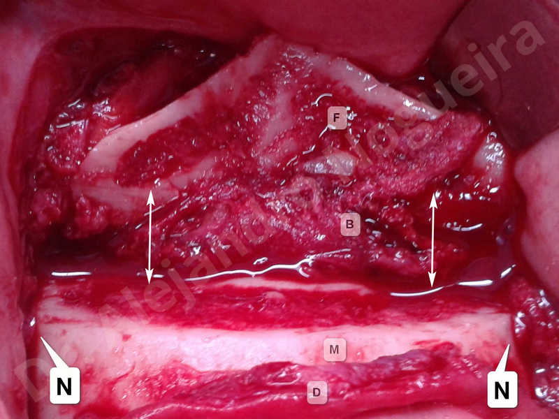 Large chin,Prominent chin,Horizontal osseous chin resection,Oblique chin osteotomy,Osseous chin setback,Three dimensional genioplasty,Vertical osseous chin resection - photo 11