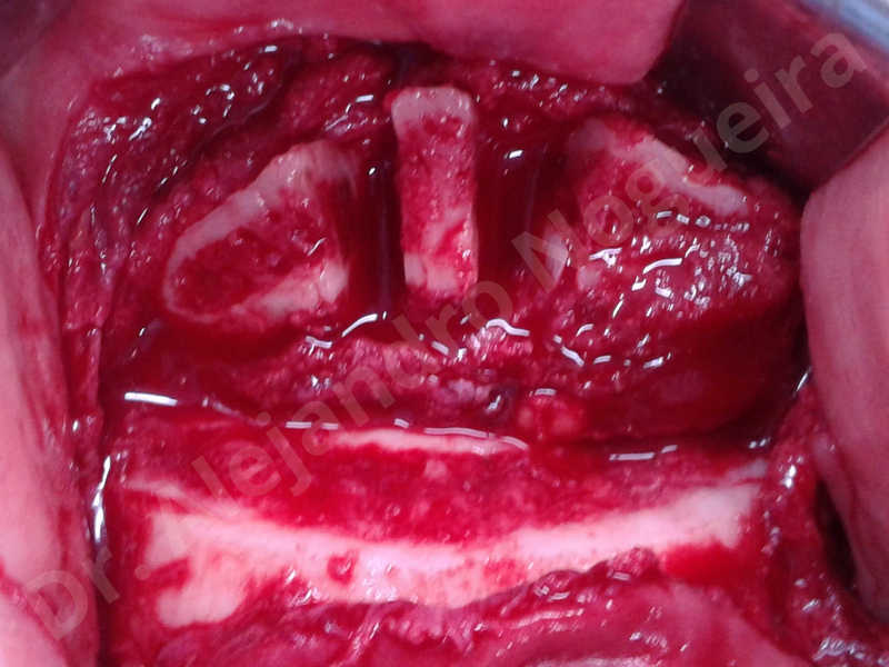 Large chin,Prominent chin,Horizontal osseous chin resection,Oblique chin osteotomy,Osseous chin setback,Three dimensional genioplasty,Vertical osseous chin resection - photo 15