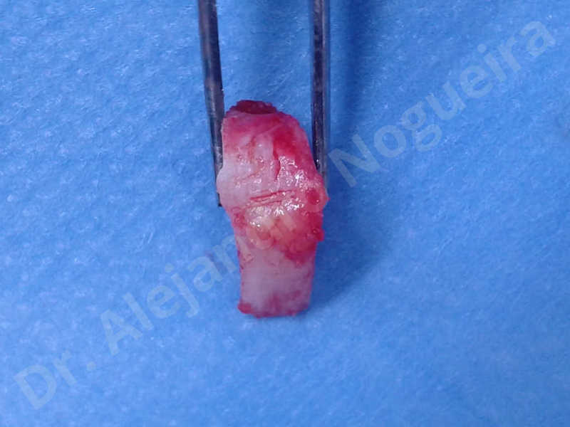 Large chin,Prominent chin,Horizontal osseous chin resection,Oblique chin osteotomy,Osseous chin setback,Three dimensional genioplasty,Vertical osseous chin resection - photo 19