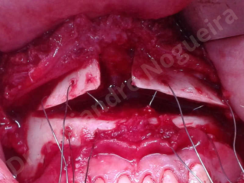 Large chin,Prominent chin,Horizontal osseous chin resection,Oblique chin osteotomy,Osseous chin setback,Three dimensional genioplasty,Vertical osseous chin resection - photo 24