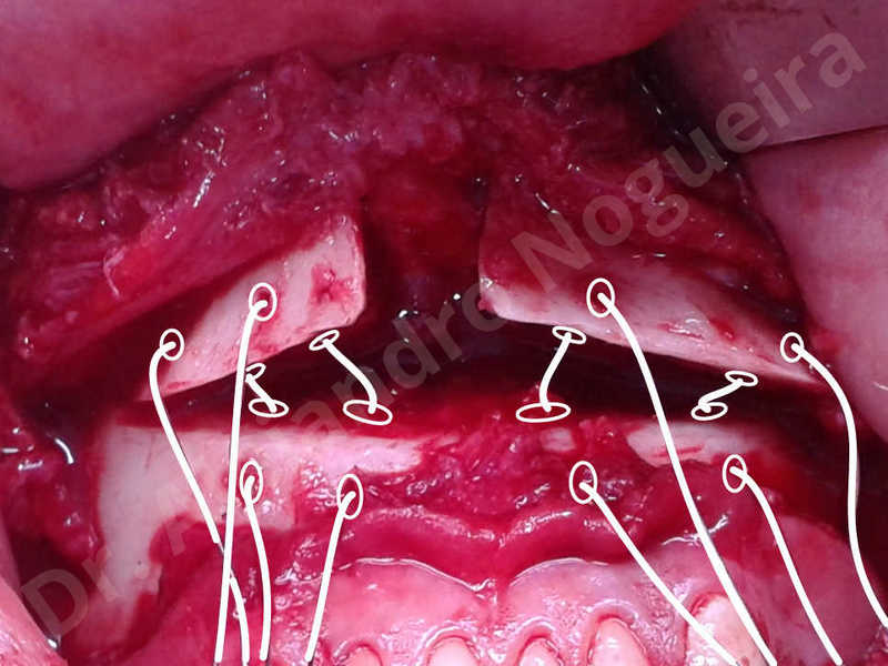 Large chin,Prominent chin,Horizontal osseous chin resection,Oblique chin osteotomy,Osseous chin setback,Three dimensional genioplasty,Vertical osseous chin resection - photo 25