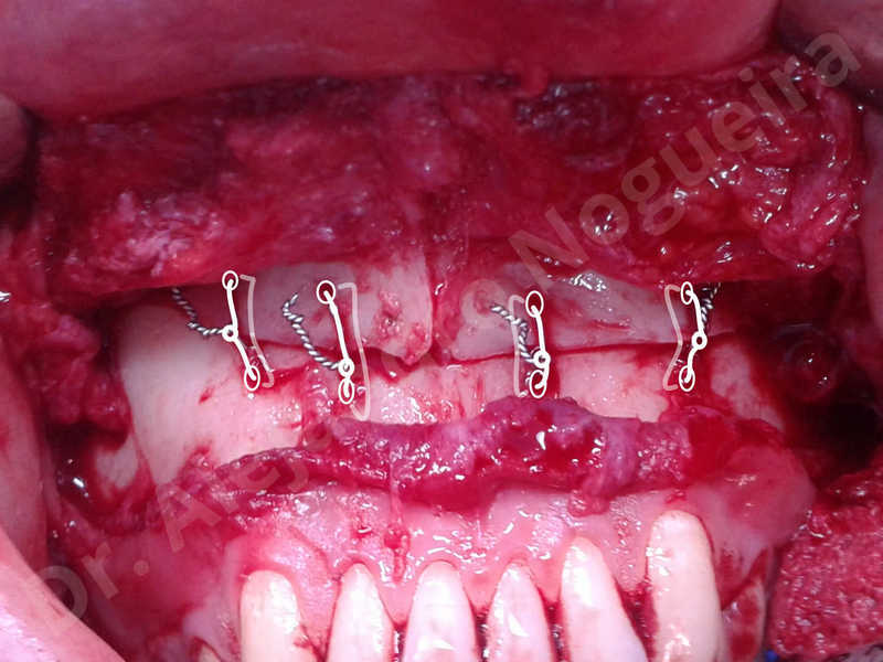 Large chin,Prominent chin,Horizontal osseous chin resection,Oblique chin osteotomy,Osseous chin setback,Three dimensional genioplasty,Vertical osseous chin resection - photo 27