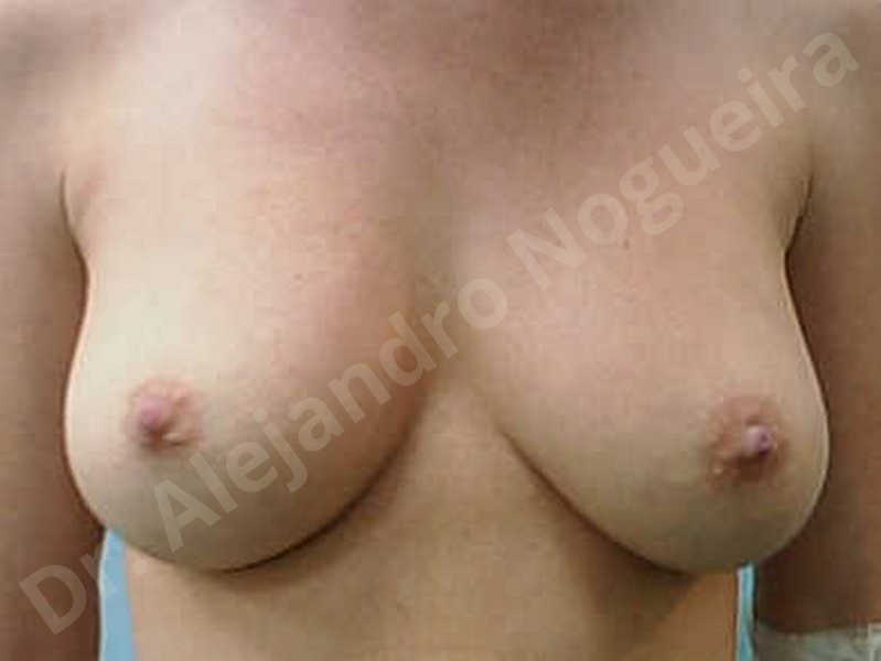Asymmetric breasts,Breast implants lateral slide,Empty breasts,Lateral breasts,Mildly saggy droopy breasts,Moderately saggy droopy breasts,Too far apart wide cleavage breast implants,Too narrow breast implants,Wide breasts,Capsulectomy - photo 1