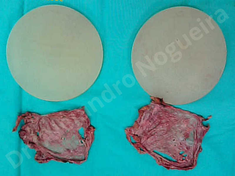 Asymmetric breasts,Breast implants lateral slide,Empty breasts,Lateral breasts,Mildly saggy droopy breasts,Moderately saggy droopy breasts,Too far apart wide cleavage breast implants,Too narrow breast implants,Wide breasts,Capsulectomy - photo 2