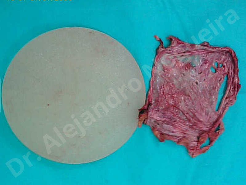 Asymmetric breasts,Breast implants lateral slide,Empty breasts,Lateral breasts,Mildly saggy droopy breasts,Moderately saggy droopy breasts,Too far apart wide cleavage breast implants,Too narrow breast implants,Wide breasts,Capsulectomy - photo 3