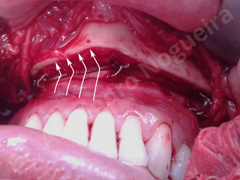 Small chin,Weak chin,Horizontal chin osteotomy,One dimensional genioplasty,Osseous chin advancement - photo 10
