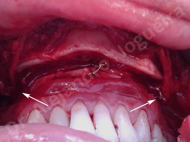 Small chin,Weak chin,Horizontal chin osteotomy,One dimensional genioplasty,Osseous chin advancement - photo 11