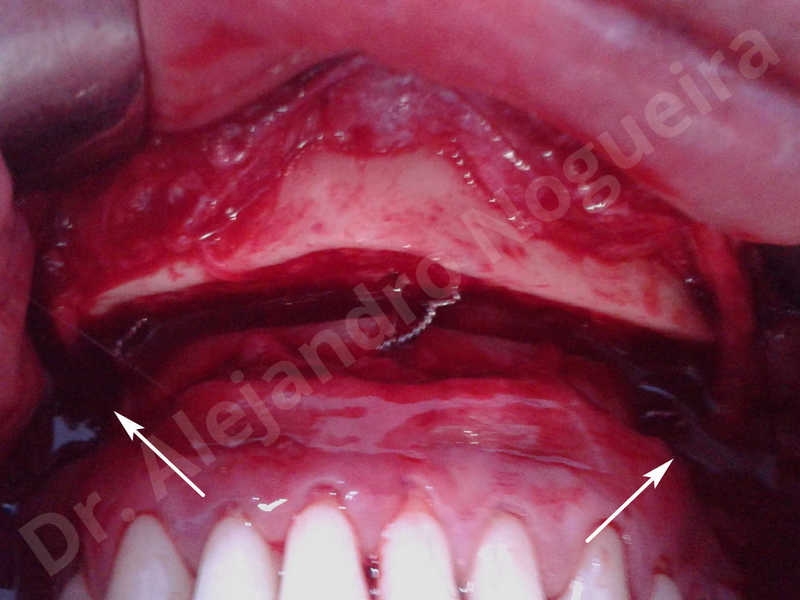 Small chin,Weak chin,Horizontal chin osteotomy,One dimensional genioplasty,Osseous chin advancement - photo 12