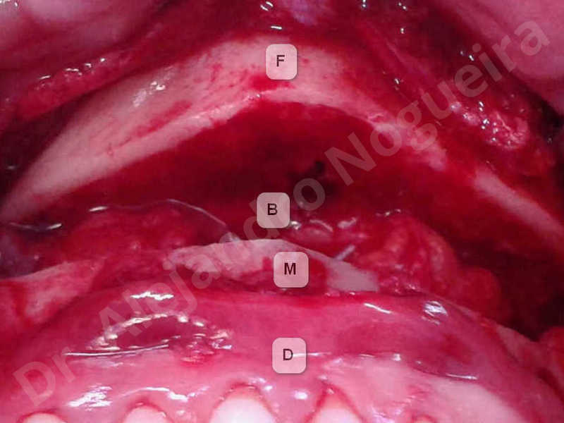 Small chin,Weak chin,Horizontal chin osteotomy,One dimensional genioplasty,Osseous chin advancement - photo 7